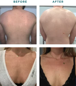 Before & After VI Chemical Peels Treatment | HTown Aesthetics PLLC | Katy, TX | Richmond, TX