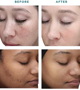 Before & After VI Chemical Peels Treatment | HTown Aesthetics PLLC | Katy, TX | Richmond, TX