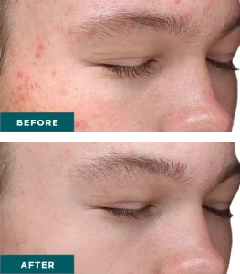 Before & After VI Chemical Peels Treatment | HTown Aesthetics PLLC | Katy, TX | Richmond, TX