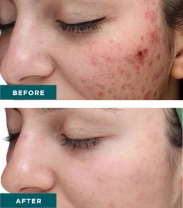 Before & After VI Chemical Peels Treatment | HTown Aesthetics PLLC | Katy, TX | Richmond, TX