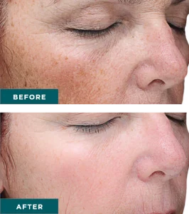 Before & After VI Chemical Peels Treatment | HTown Aesthetics PLLC | Katy, TX | Richmond, TX