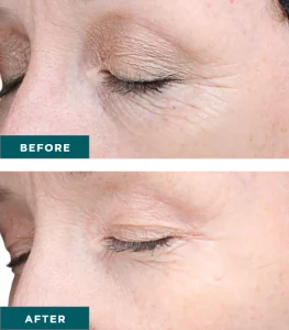 Before & After VI Chemical Peels Treatment | HTown Aesthetics PLLC | Katy, TX | Richmond, TX