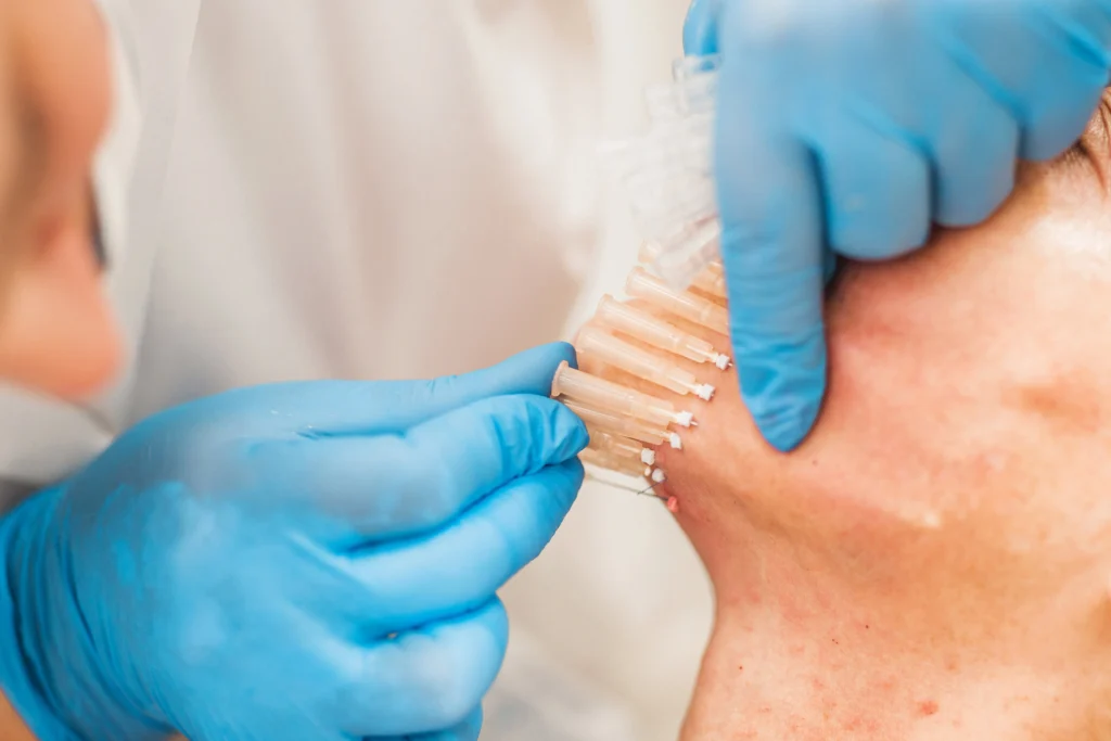 PDO Threads injected on woman's face | HTown Aesthetics PLLC | Katy, TX | Richmond, TX