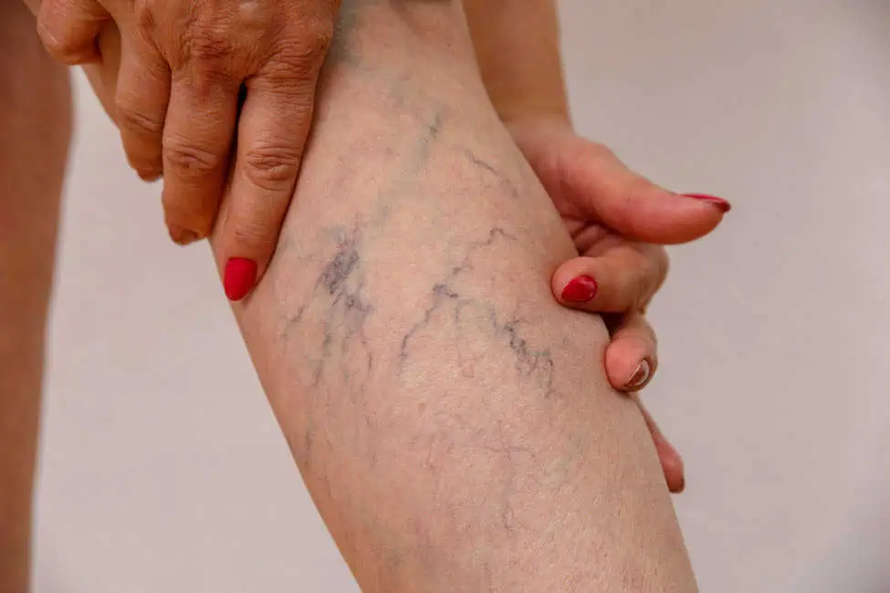 Varicose Veins by H Town Aesthetics in Texas