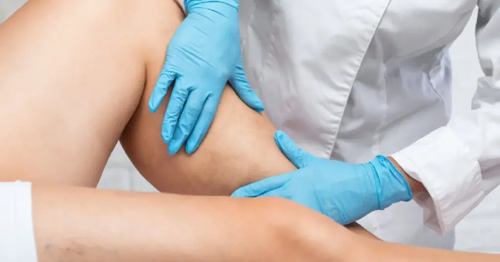 Vein Removal in Katy, TX
