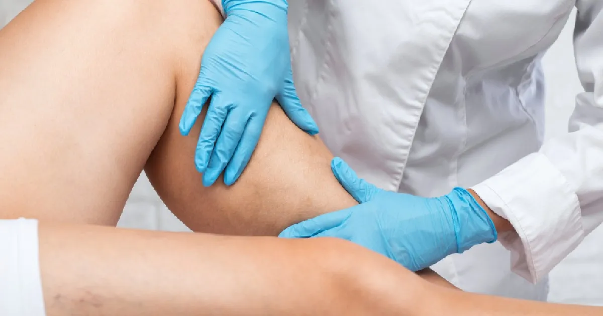 Vein Removal in Katy, TX