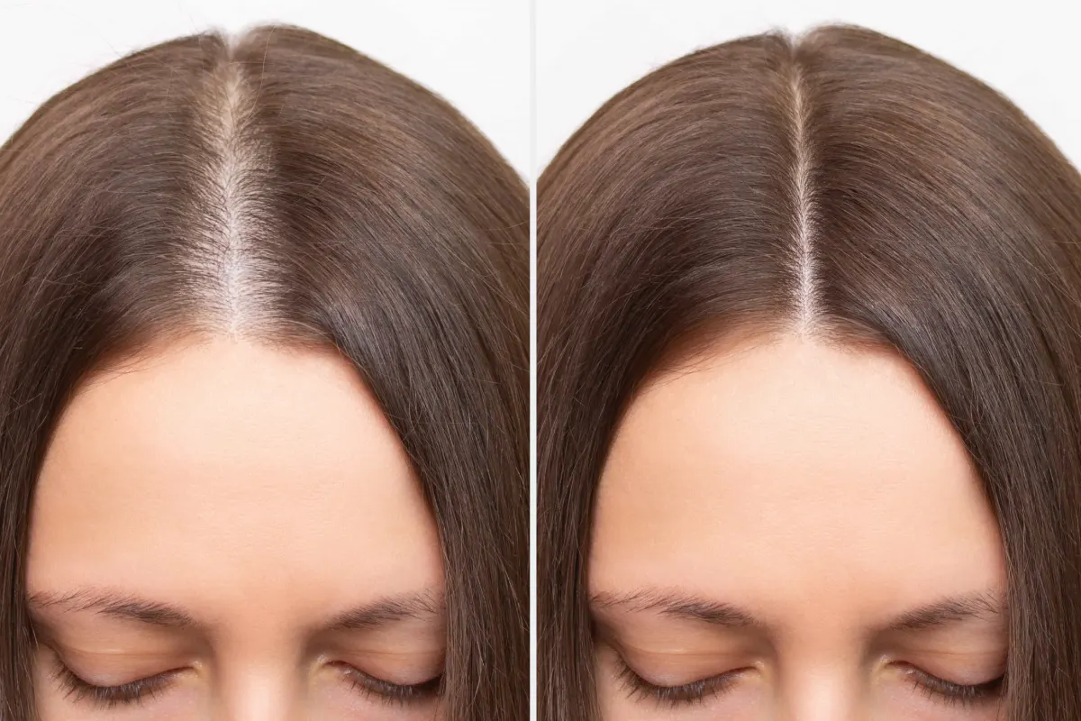 Woman showing visible hair regrowth after hair restoration procedure