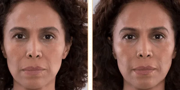 Sculptra Before & After Treatment | HTown Aesthetics PLLC | Katy, TX | Richmond, TX