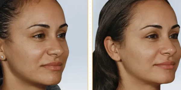 Sculptra Before & After Treatment | HTown Aesthetics PLLC | Katy, TX | Richmond, TX