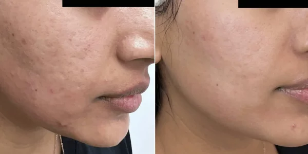 Before & After Secret RF Microneedling Treatment | HTown Aesthetics PLLC | Katy, TX | Richmond, TX