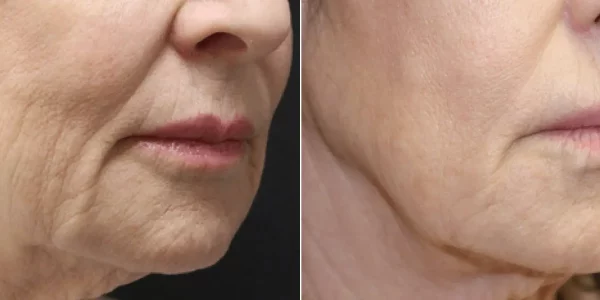 Before & After Secret RF Microneedling Treatment | HTown Aesthetics PLLC | Katy, TX | Richmond, TX