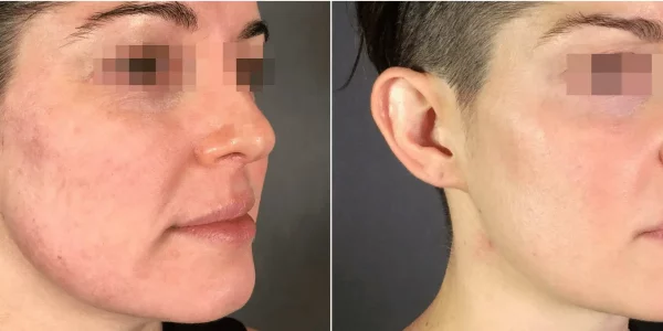 Before & After Secret RF Microneedling Treatment | HTown Aesthetics PLLC | Katy, TX | Richmond, TX