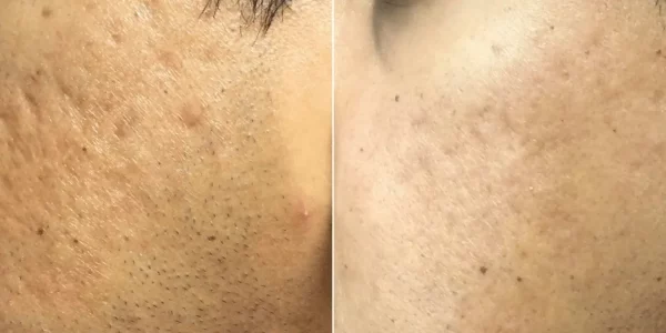 Before & After Secret RF Microneedling Treatment | HTown Aesthetics PLLC | Katy, TX | Richmond, TX