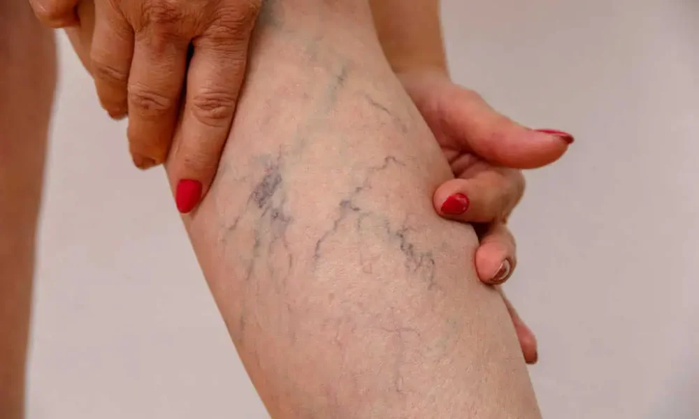 Varicose Veins by H Town Aesthetics in Texas