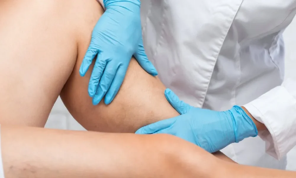 Vein Removal in Katy, TX